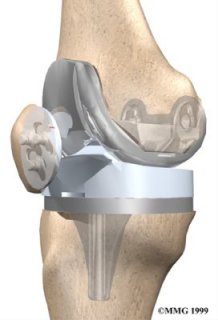 Total Knee Replacement