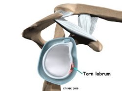 Labral Tear