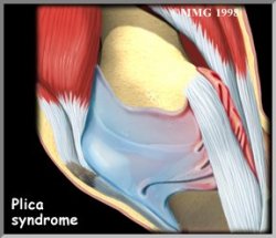 Plica Syndrome