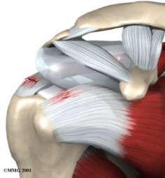 Shoulder Rotator Cuff Injury