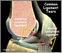 MCL Tears - Mark W. Maffet, M.D.