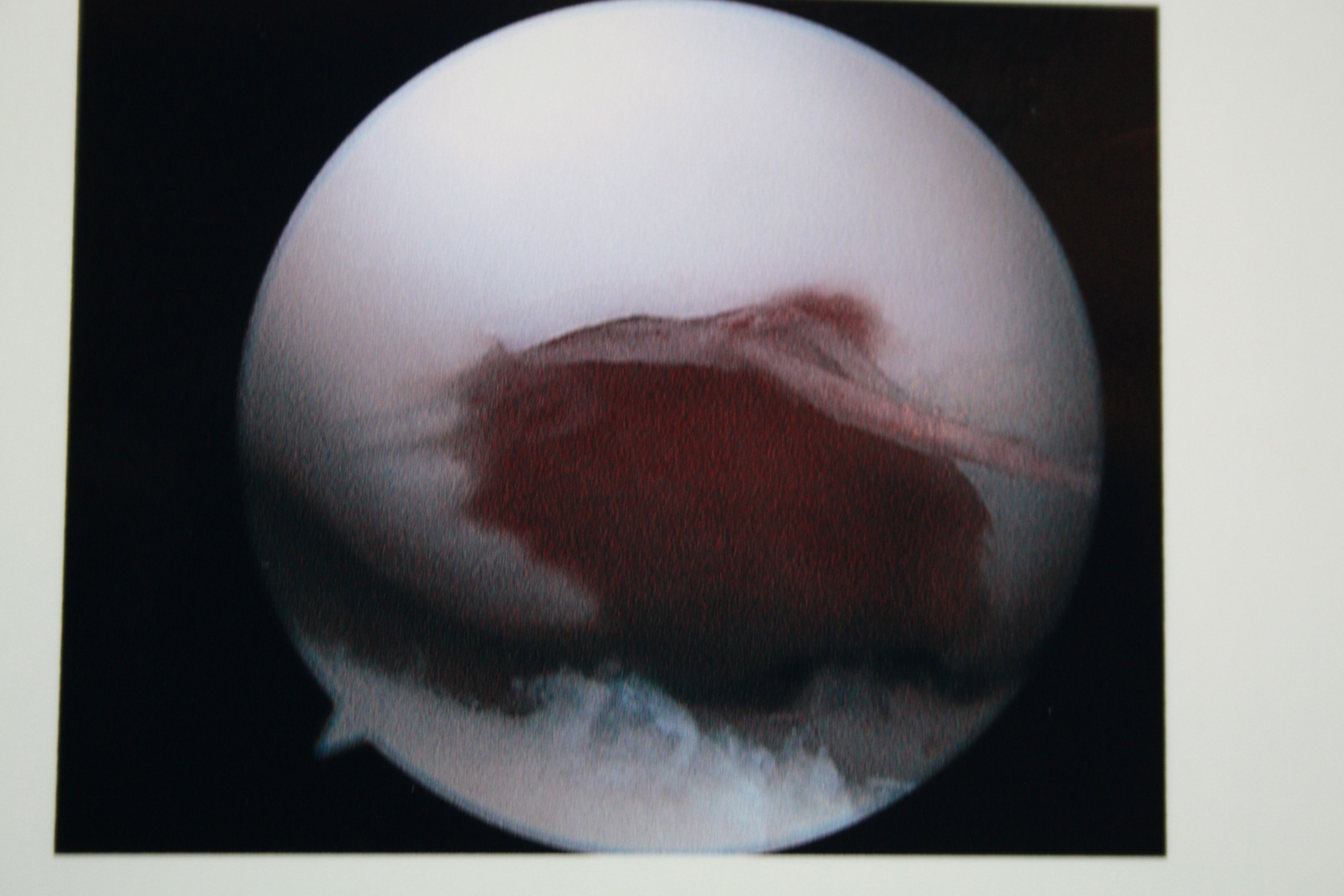 14 year old girl with acute injury to articular cartilage.