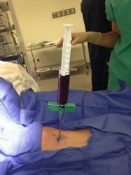 Bone marrow aspiration