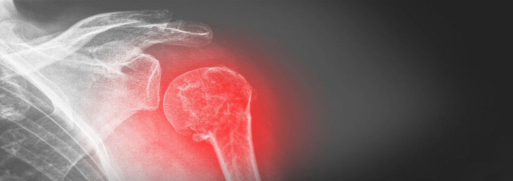 Shoulder Injury? Dr. Maffet can help!